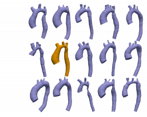 Set of geometries of aortic coarctation
